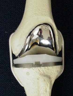 Figure 6 - Model of a knee replacement prosthesis