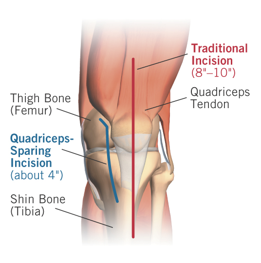 Figure 1 - The incision used for minimally-invasive quadriceps-sparing total knee replacement is much smaller than the one used for traditional knee replacement and in the less-invasive procedure the important quadriceps muscle and tendon are not disrupted as in traditional knee replacement. LifeART image ©2004 Lippincott Williams & Wilkins. All rights reserved.