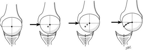 Figure 2 - Normally the humeral head must climb out of the depth of the glenoid to translate across its face