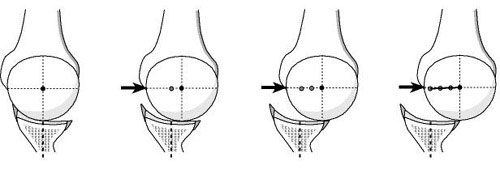 Figure 3 - When the posterior aspect of the socket is flat there is minimal resistance to posterior translation of the humeral head across the glenoid