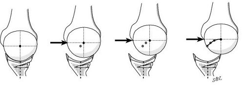 Figure 4 - The posterior glenoid osteoplasty restores the posterior glenoid concavity and the posterior glenoidogram
