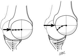 Figure 5 - The change in glenoid shape and glenoidogram from before to after the surgery is dramatic