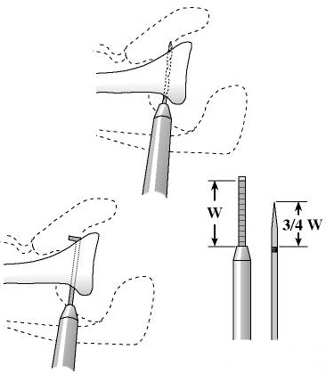 Figure 16 - The plane of the intended glenoid osteotomy is determined parallel to and one centimeter medial to the articular surface. A drill hole is made from anterior to posterior in the plane of the intended osteotomy. The depth of this hole is measured with a depth gauge revealing the anteroposterior dimension of the glenoid in the plane of the intended osteotomy. A 3/4 inch flat and strong osteotome is marked with sterile tape at a length equal to 3/4 of the anteroposterior dimension of the glenoid.
