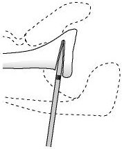 Figure 17 - The depth of the osteotome is controlled by paying attention to the sterile tape mark