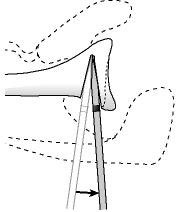 Figure 19 - A posterior inferior opening wedge osteotomy is created one centimeter medial to the glenoid lip in the same as the face of the glenoid articular surface. The depth of the osteotome is controlled by paying attention to the sterile tape mark. This osteotomy is opened with successive levering steps to ?bend? the bone rather than breaking. The glenoid surface is observed as the osteotomy is deepened to prevent penetration of the joint surface.