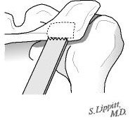 Figure 20 - The bone graft is harvested using an oscillating saw