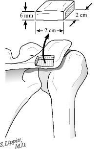 Figure21 - A 20 mm x 20 mm x 6 mm bone graft is harvested from the posterior superior scapular spine