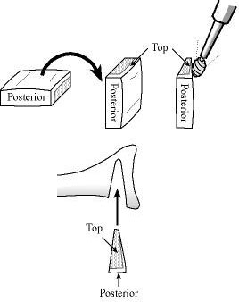 Figure22 - The bone graft is fashioned to a 20 mm x 15 mm x 5 mm wedge using a pine cone burr