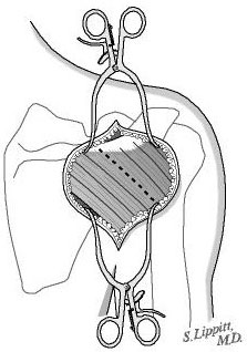 Figure 8 - The posterior deltoid is split between its posterior one third and its anterior two thirds beginning two centimeters medial to the posterior corner of the