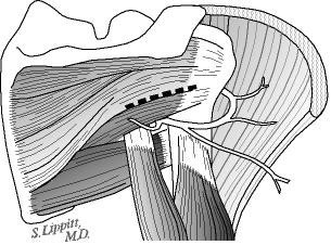 Figure 11 - Looking at the shoulder with the deltoid muscle reflected we can see the axillary nerve exiting the quadrilateral space (between the long head of the triceps the humeral shaft the teres minor and the teres major). The shoulder capsule is approached as indicated by the dotted line between the infraspinatus and the teres minor. The teres minor protects the axillary nerve during the procedure.