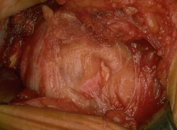 Rotator cuff small rotator cuff tear
