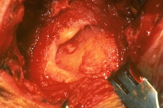 Rotator cuff large rotator cuff tear