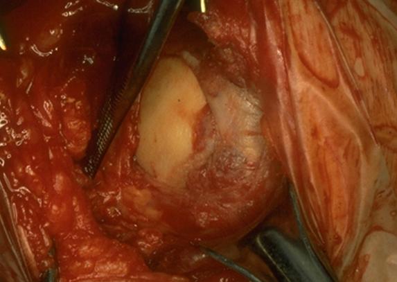 Rotator cuff large rotator cuff tear with poor quality tissue