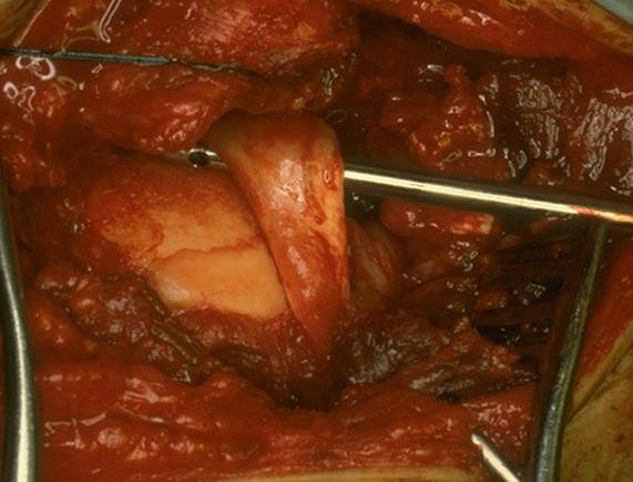 Rotator cuff massive rotator cuff tear with rotator cuff tear arthropathy