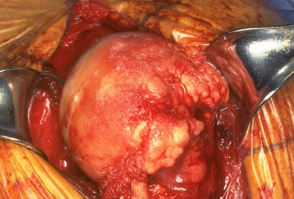 Rotator cuff rotator cuff tear arthropathy