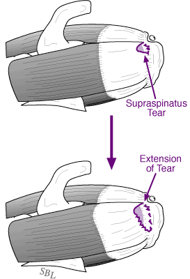 Figure 2 - Supraspinatus tear of the rotator cuff
