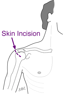 Figure 4 - Location of incision