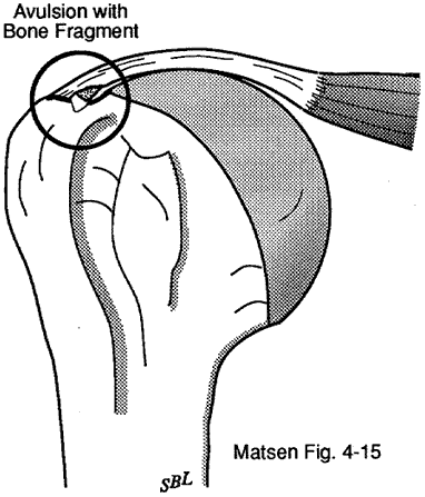 Figure 3 - Avulsion of bone from the tuberosity