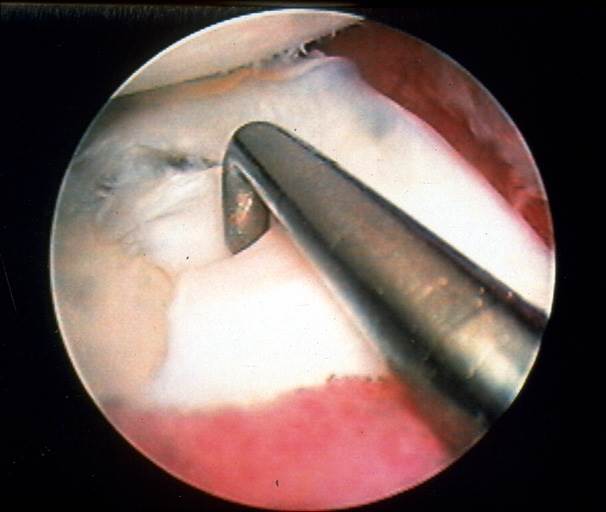 Torn Meniscus - A tear in the non-vascular region of the meniscus as seen through the arthroscope