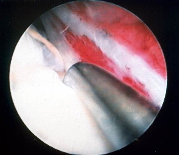 Torn Meniscus - A probe is inserted in the tear, immediately adjacent to the meniscal blood supply