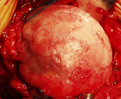 Figure 1 - Humeral head that has been damaged by arthritis.