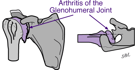 Figure 3 - Glenoid bone spurs: The figure on the left shows bone spurs at the bottom of the joint. The figure on the right shows that the ball is not centered and has worn down the back part of the socket.