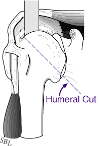 Figure 7 - Humeral Cut: the amount of the damaged ball that is removed.
