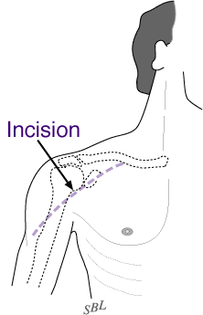 Figure 9 - Axillary incision