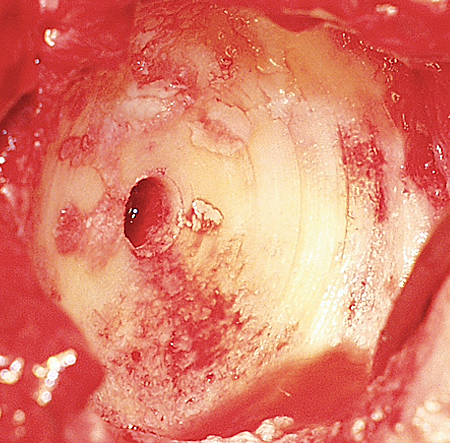 Figure 13 - Arthritic glenoid after it has been reamed
