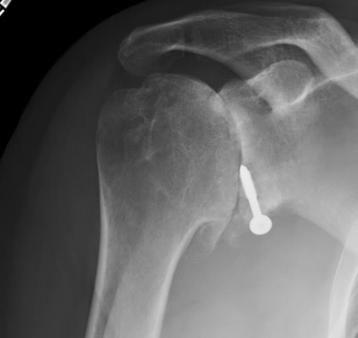 Shoulder and Elbow Cases to Consider | UW Orthopaedics and Sports