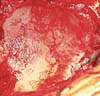 shoulder arthritis - arthritic glenoid (socket)