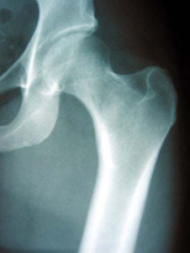 Figure 1 Hip Arthritis Normal Hip X Ray Figure 1 Hip Arthritis Normal Hip X Ray