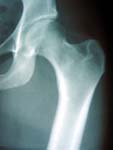 Fig. 2 - Normal hip x-ray Hip Arthritis - Normal hip x-ray