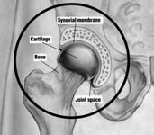 Fig. 3 - Normal hip cartialge. Hip Artritis - Normal hip cartilage