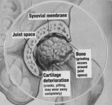 Fig. 4 - Arthritic Hip Cartilage Hip Arthritis - Arthritic Hip Carilage