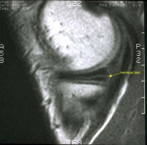 Torn Meniscus UW Orthopaedics and Sports Medicine, Seattle