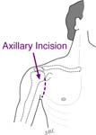 Bankart Lesion Bankart Lesion Fig 13 - Axillary incision leaves a small scar