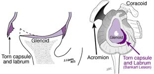 Bankart Lesion Bankart Lesion Fig 17 - Torn capsule and labrum