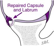 Bankart Lesion Bankart Lesion Fig 18 - Repaired Capsule and Labrum