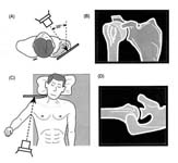 Bankart Lesion Bankart Lesion Fig 2 - Shoulder dislocation. AP and Axillary x-ray views