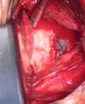 Bankart Lesion Bankart Lesion Fig 6 - Shoulder dislocation - Failed arthroscopic Bankart repair