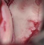 Bankart Lesion Bankart Lesion Fig 7 - Shoulder dislocation - fracture of the anterior inferior glenoid lip