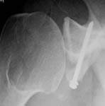 Bankart Lesion Bankart Lesion Fig 9 - Shoulder dislocation - bone block secured in place to replace glenoid bony defect