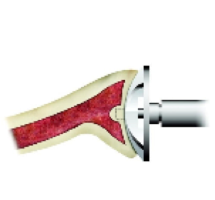 Figure 3: Reaming the glenoid. Figure 3: Reaming the glenoid.
