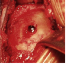 Figure 4: The reamed glenoid socket. Figure 4: The reamed glenoid socket.