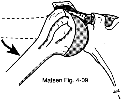 Figure 9 - The fibers of the cuff sustain eccentric loads when resisting humeral motion or displacement