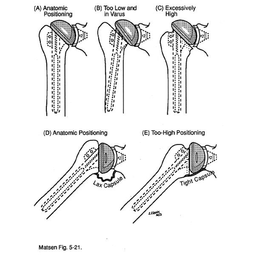 Humeral Head Retroversion Considerations Implant Biomechanics Anatomy ...