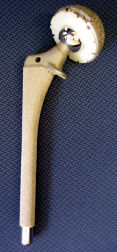 Hip Replacement typical components