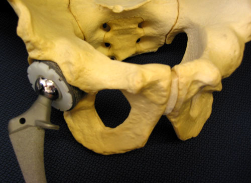 Figure 2 - Typical hip replacement components in their position relative to the hip and pelvis.