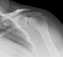 Figure 1 Shows evidence of superior migration of the humeral head.